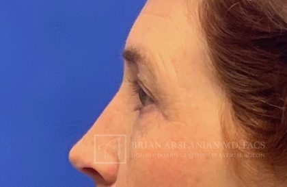 Blepharoplasty case #2118