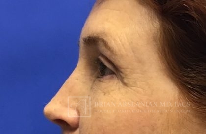 Blepharoplasty case #2118