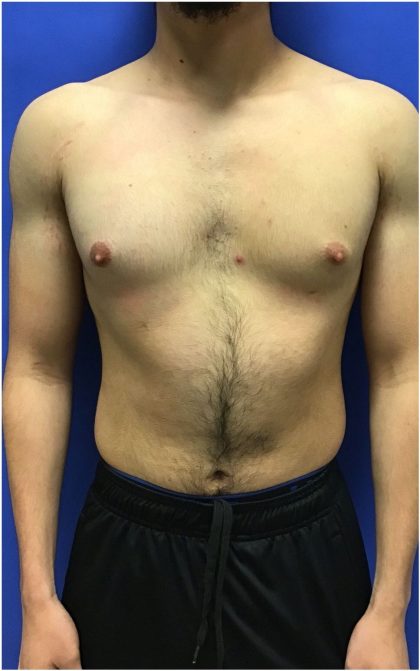 Gynecomastia case #4777