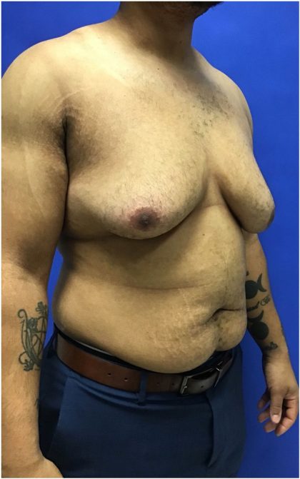 Gynecomastia case #4790