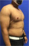 Gynecomastia case #4790