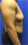 Gynecomastia case #4790