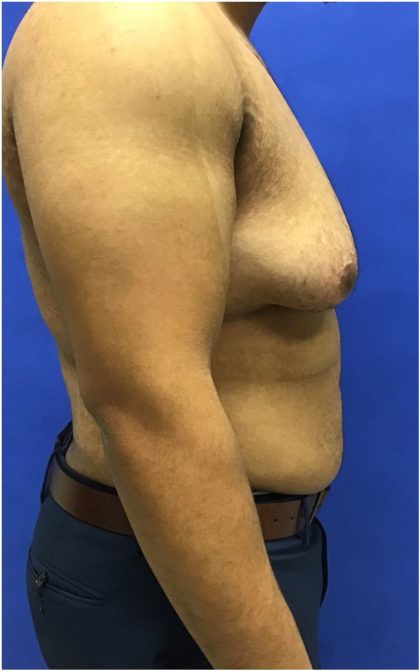 Gynecomastia case #4790