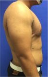 Gynecomastia case #4790