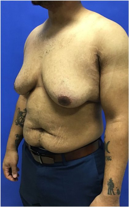 Gynecomastia case #4790