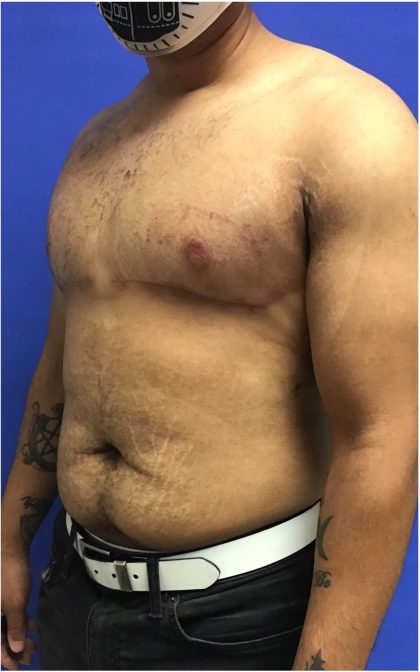 Gynecomastia case #4790