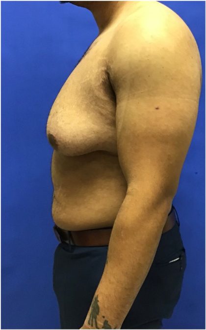 Gynecomastia case #4790