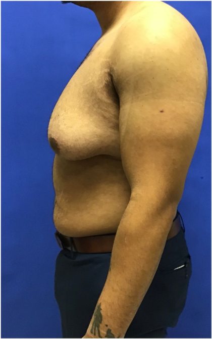 Gynecomastia case #4790