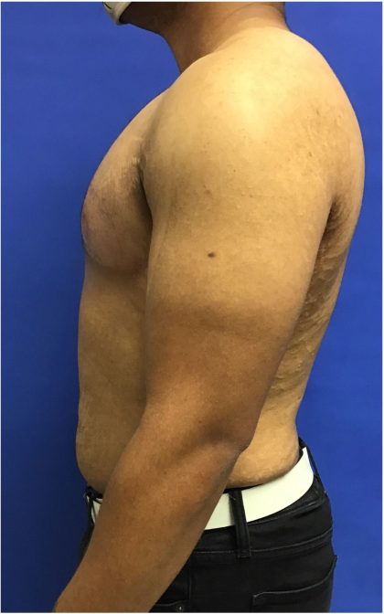 Gynecomastia case #4790