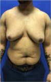 Gynecomastia case #4790