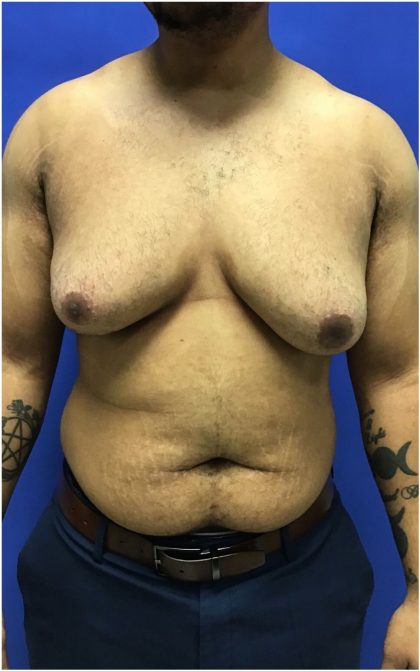 Gynecomastia case #4790