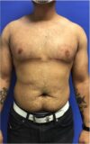 Gynecomastia case #4790