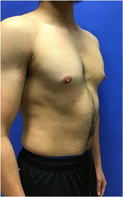 Gynecomastia case #4777