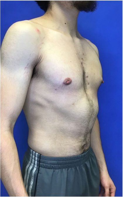 Gynecomastia case #4777