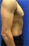 Gynecomastia case #4777