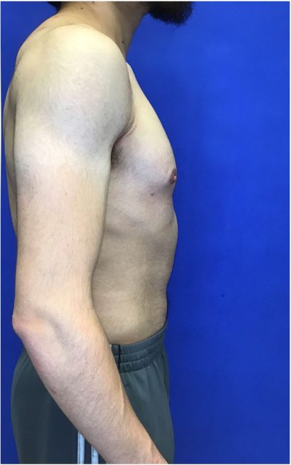 Gynecomastia case #4777