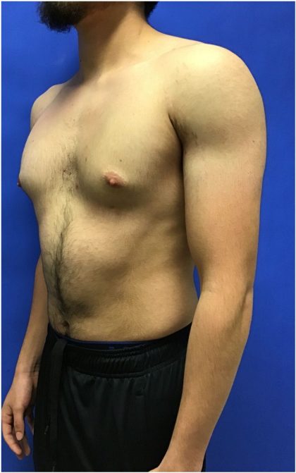 Gynecomastia case #4777