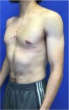 Gynecomastia case #4777