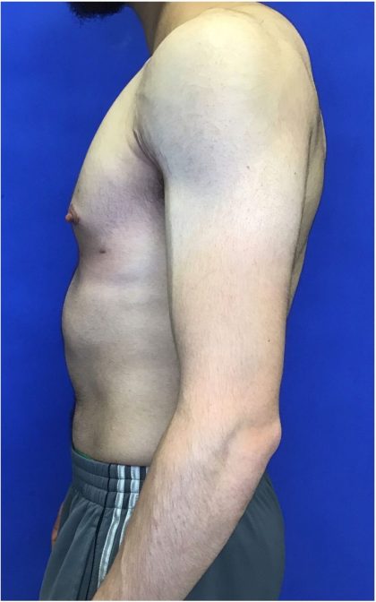 Gynecomastia case #4777