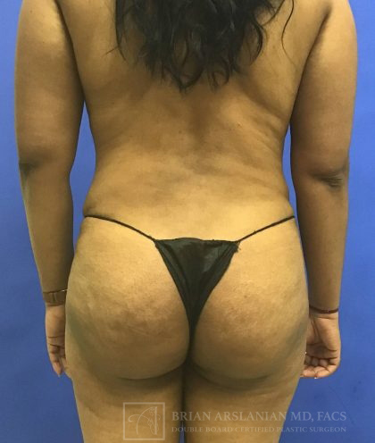 Brazilian Butt Lift case #2127