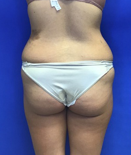 Brazilian Butt Lift case #2292