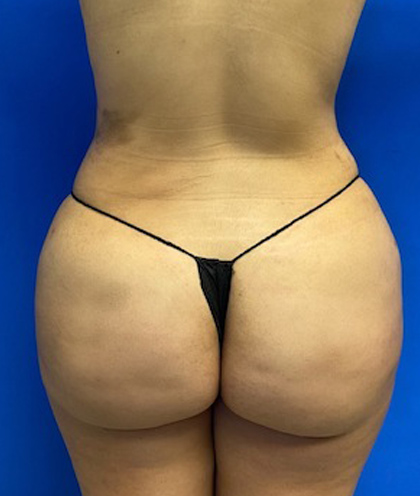 Brazilian Butt Lift case #2292