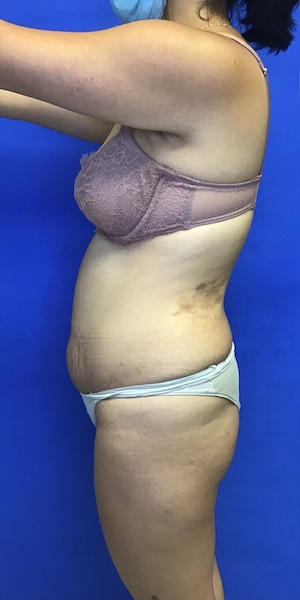 Brazilian Butt Lift case #2292