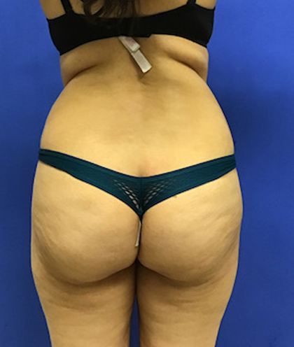 Brazilian Butt Lift case #2301