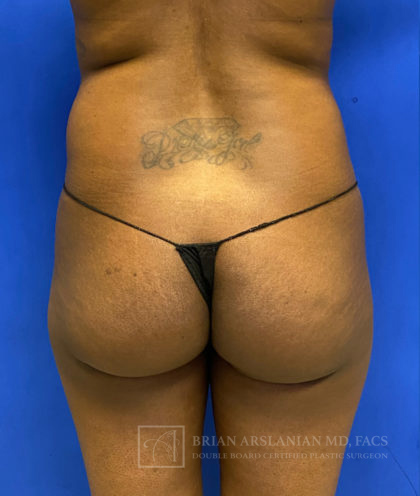 Brazilian Butt Lift case #2319