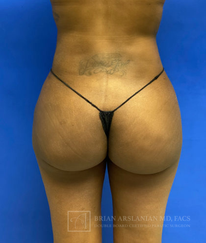 Brazilian Butt Lift case #2319