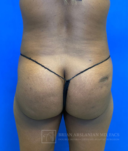 Brazilian Butt Lift case #2329