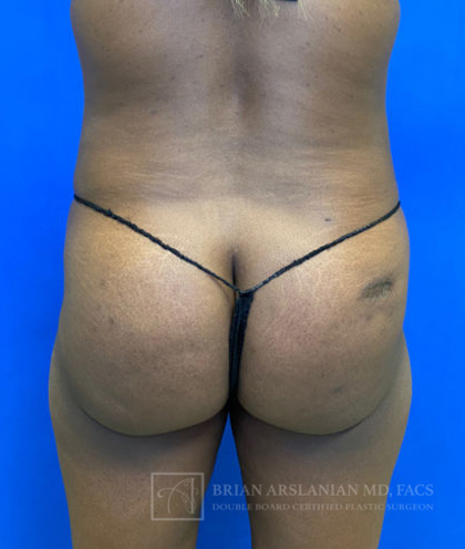 | Arslanian Plastic Surgery Atlanta Before & After Plastic Surgery Results | body procedure