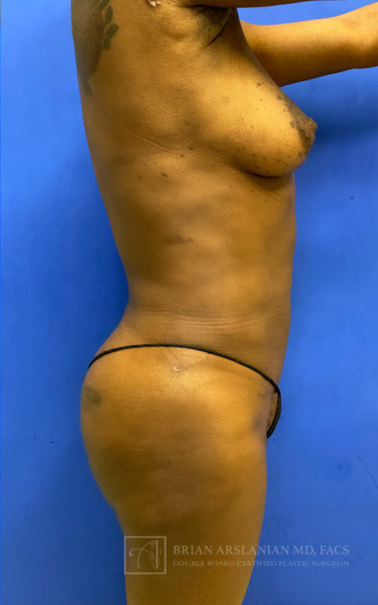 Brazilian Butt Lift case #2329