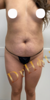 Brazilian Butt Lift case #2338