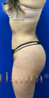 Brazilian Butt Lift case #2338