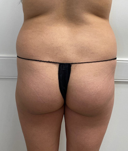 Brazilian Butt Lift case #2347