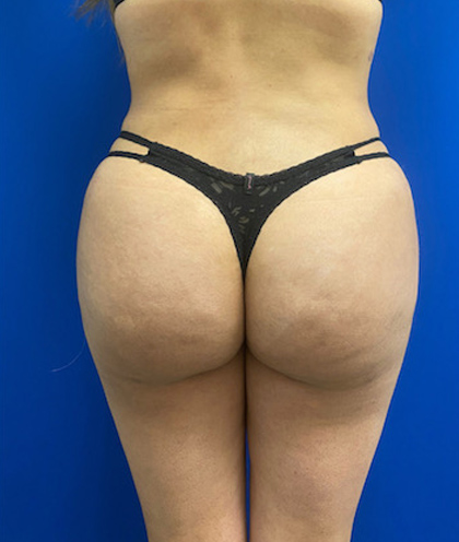 Brazilian Butt Lift case #2347