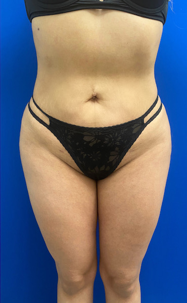 Brazilian Butt Lift case #2347