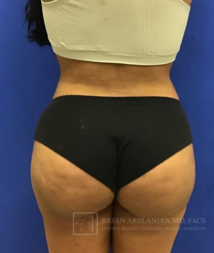 Brazilian Butt Lift case #2138