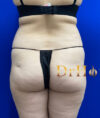 Brazilian Butt Lift case #2363