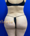 Brazilian Butt Lift case #2363