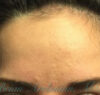 Botox® case #2385