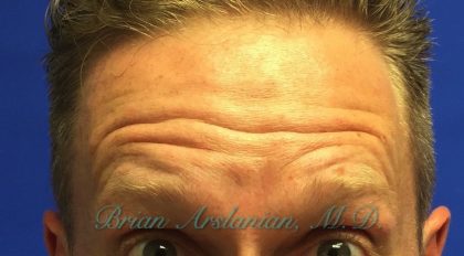 Botox® case #2388