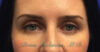 Botox® case #2400