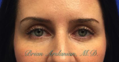 Botox® case #2400