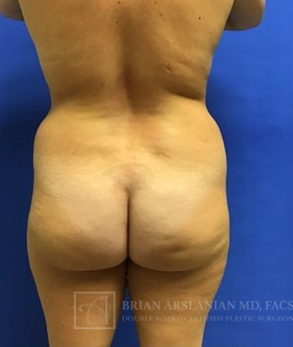 Brazilian Butt Lift case #2151