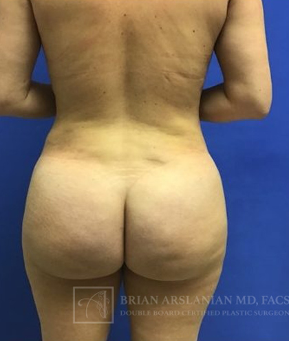 Brazilian Butt Lift case #2151