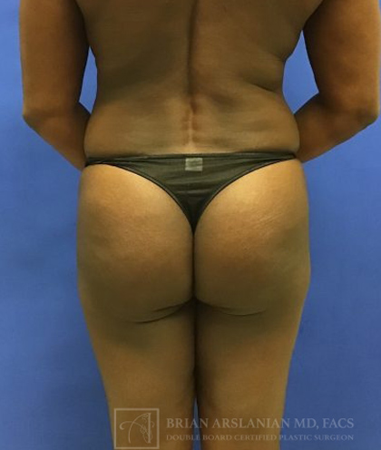 Brazilian Butt Lift case #2206