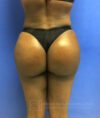 Brazilian Butt Lift case #2206