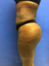 Brazilian Butt Lift case #2206